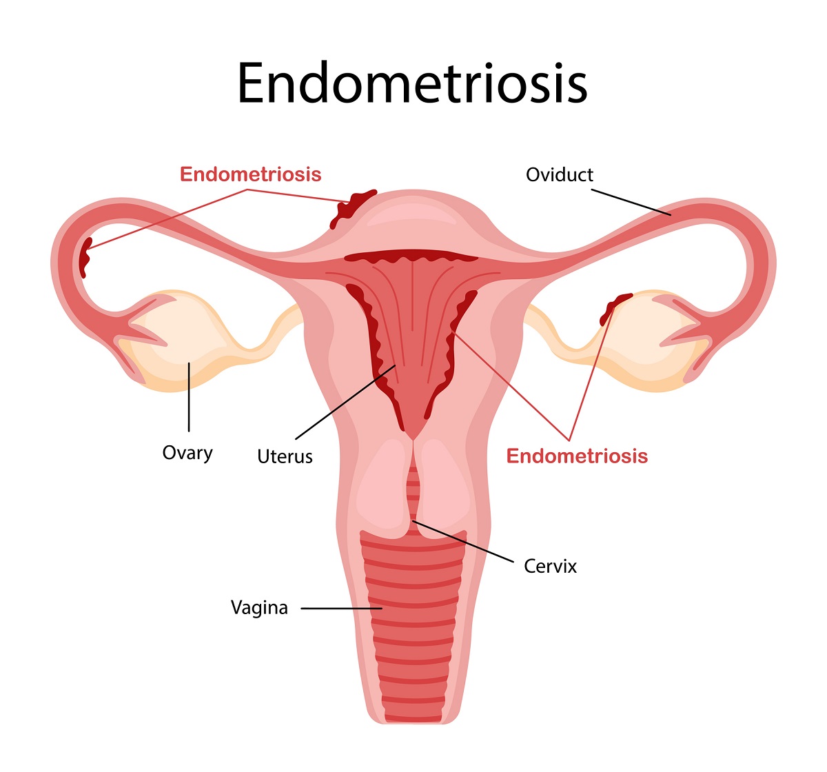 Endometrióza a výskyt endometria mimo dutiny maternice